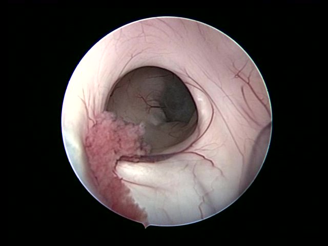 Endoscopic Brain Surgery