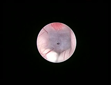 Endoscopic Brain Surgery