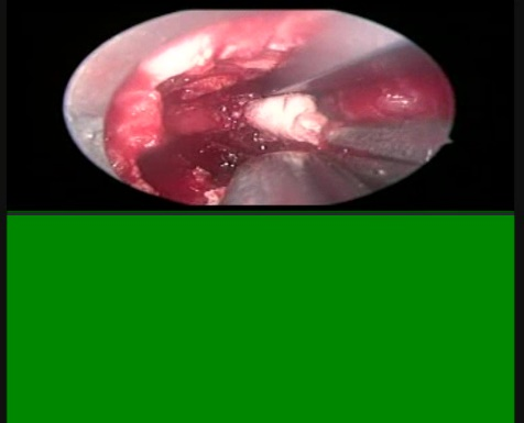 Spine Surgery