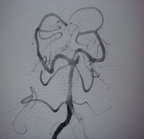 Preop SCA Aneurysm