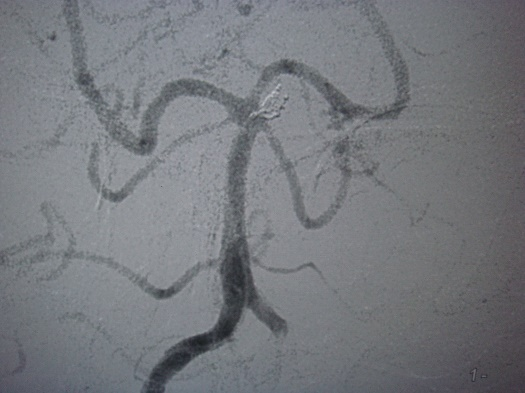 Postop SCA Aneurysm