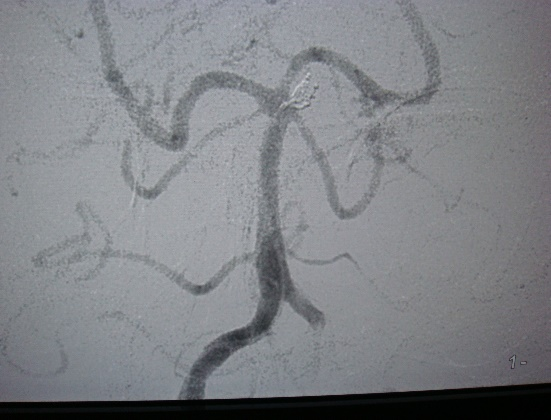 Postop SCA Aneurysm